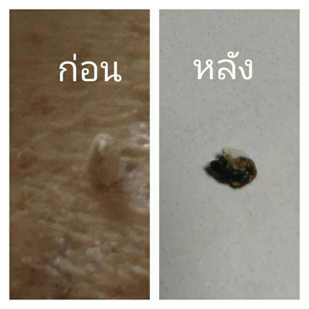 ผลิตภัณฑ์กำจัดติ่งเนื้อ กระเนื้อ สิวหิน สูตรโบราณแท้ 100%