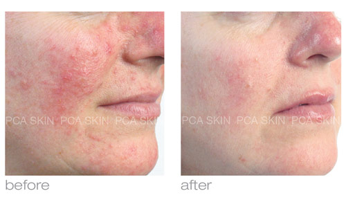 PCA Skin PCA Skin Sensi Peel 1.96oz/58ml 58 กรัม