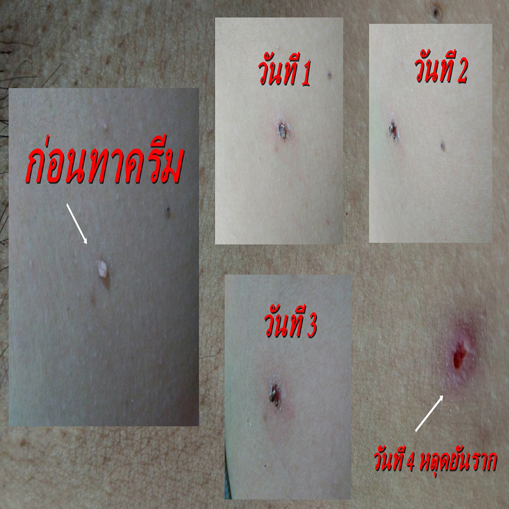 Clear Up ครีม กำจัด ไฝ หูด ตาปลา ติ่งเนื้อ ขี้แมลงวัน สูตรธรรมชาติ 100%