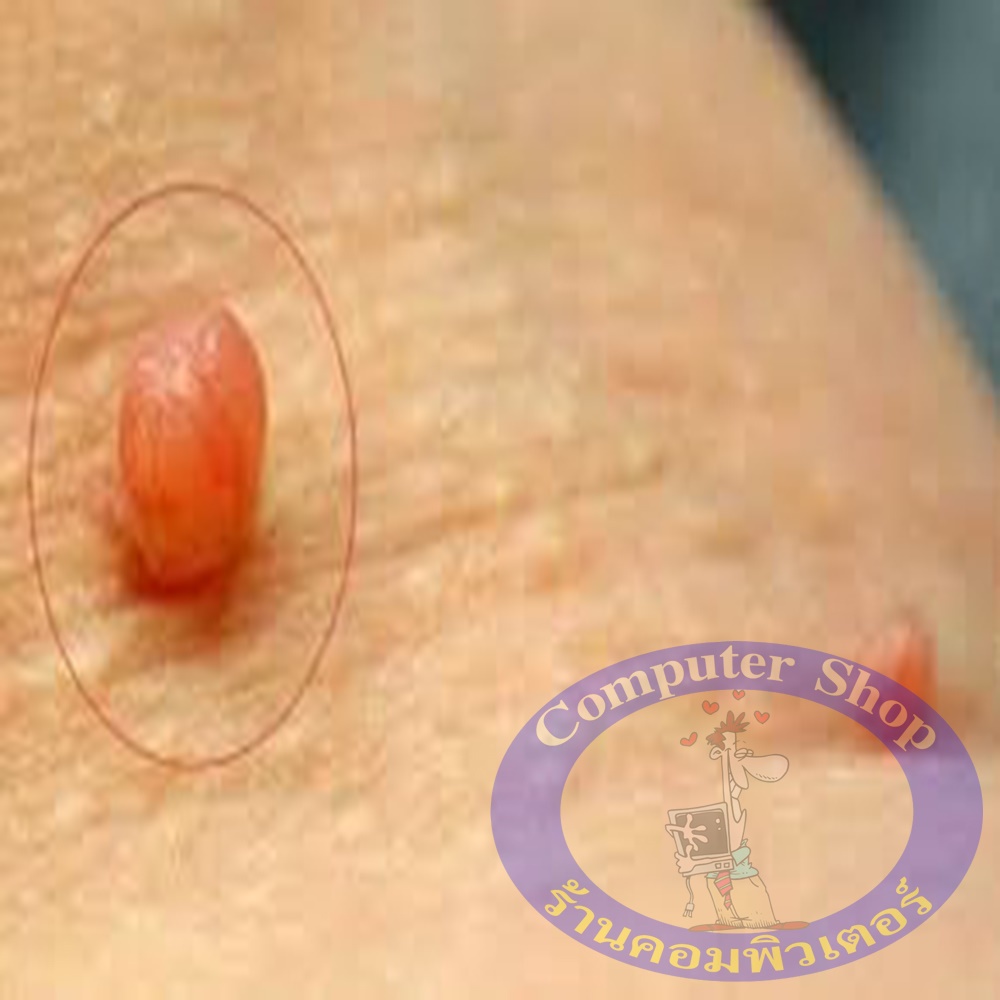 ผลิตภัณฑ์กำจัดติ่งเนื้อ กระเนื้อ สิวหิน สูตรโบราณแท้ 100%