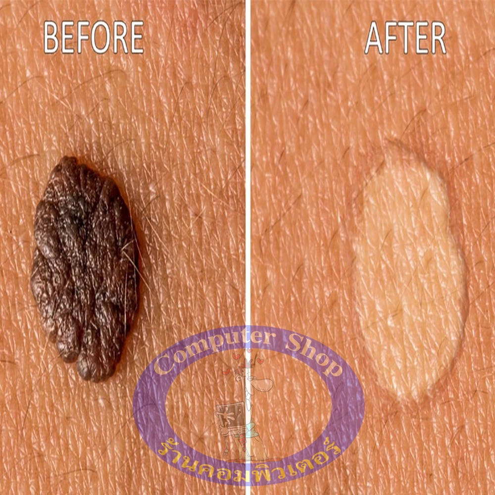 ผลิตภัณฑ์กำจัดติ่งเนื้อ กระเนื้อ สิวหิน สูตรโบราณแท้ 100%