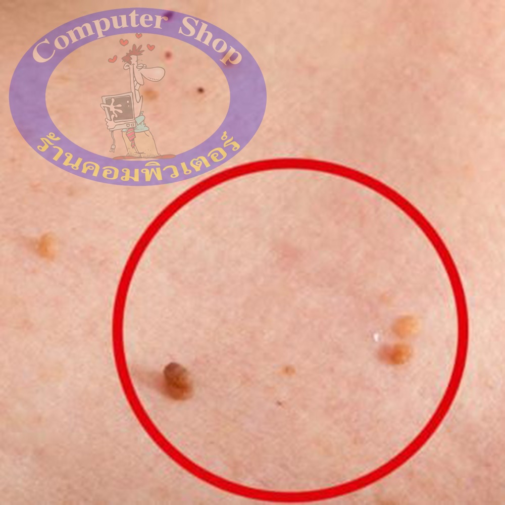 ผลิตภัณฑ์กำจัดติ่งเนื้อ กระเนื้อ สิวหิน สูตรโบราณแท้ 100%