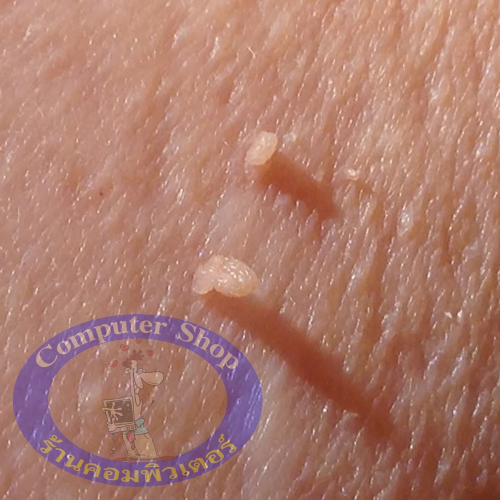 ผลิตภัณฑ์กำจัดติ่งเนื้อ กระเนื้อ สิวหิน สูตรโบราณแท้ 100%