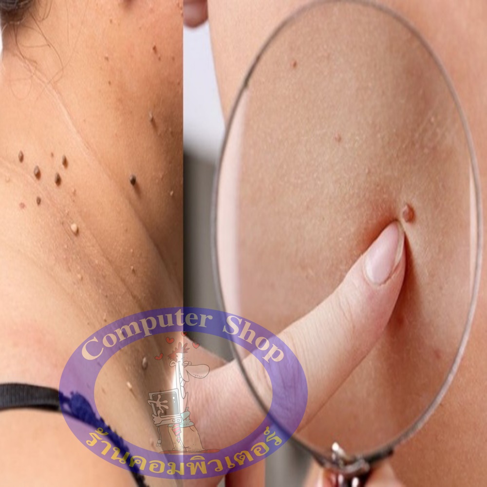 ผลิตภัณฑ์กำจัดติ่งเนื้อ กระเนื้อ สิวหิน สูตรโบราณแท้ 100%