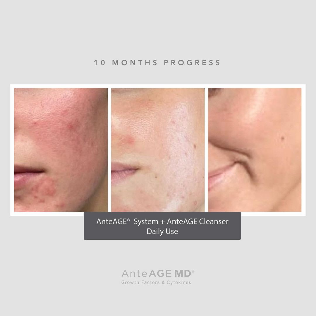 AnteAGE MD Serum (30ml) 0 กก.