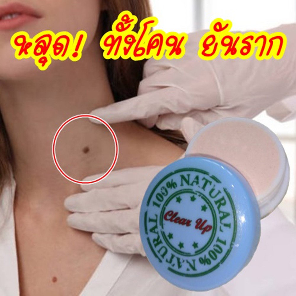 Clear Up ครีม กำจัด ไฝ หูด ตาปลา ติ่งเนื้อ ขี้แมลงวัน สูตรธรรมชาติ 100%