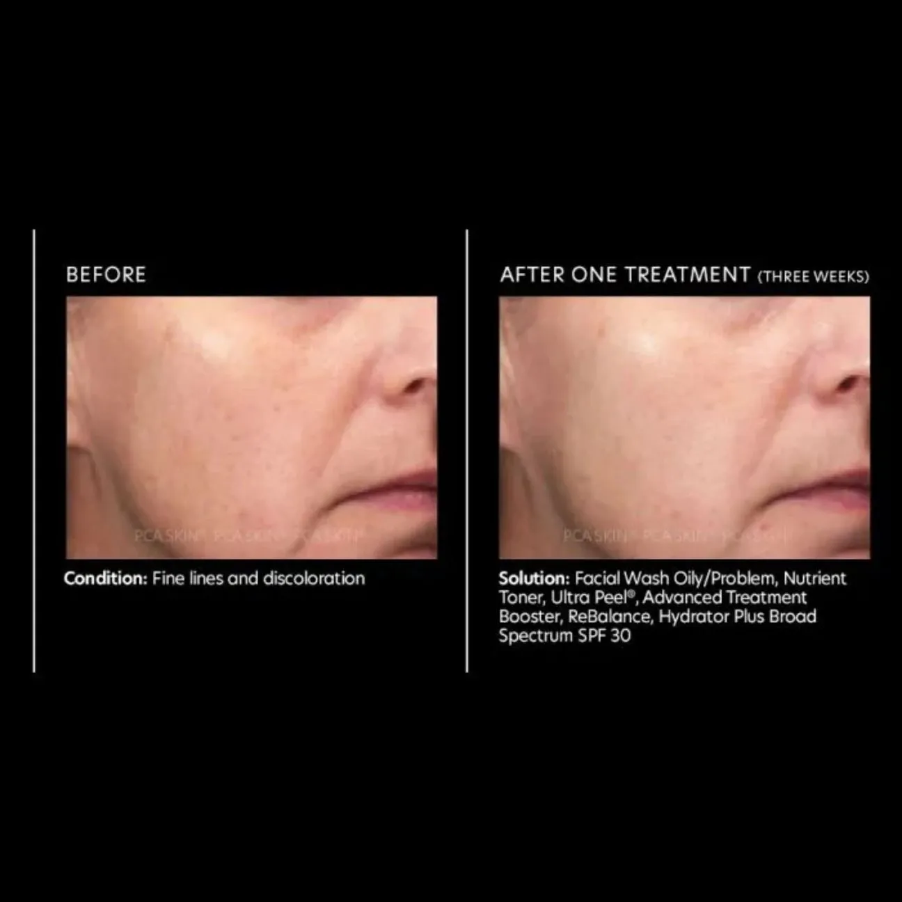 PCA Skin Ultra Peel 58ml 0 กรัม